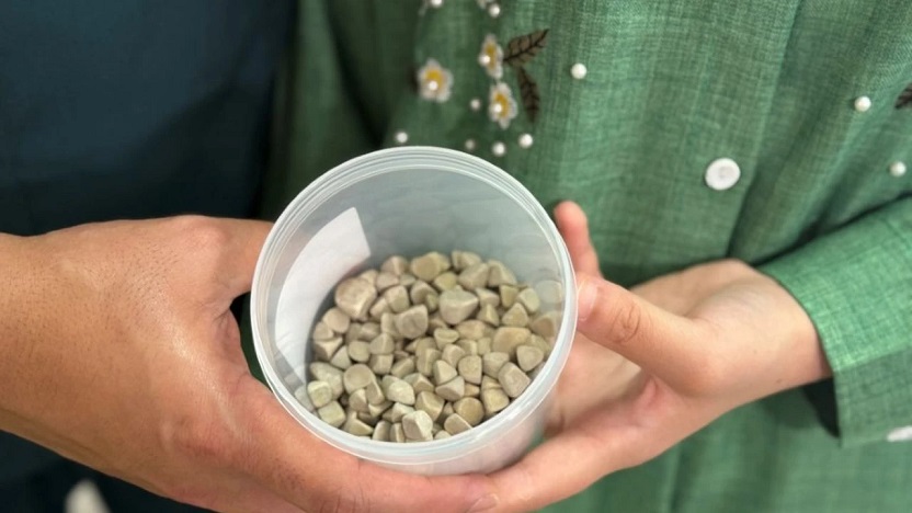 Karabük'te genç kızın vücudundan 287 adet taş çıkarıldı